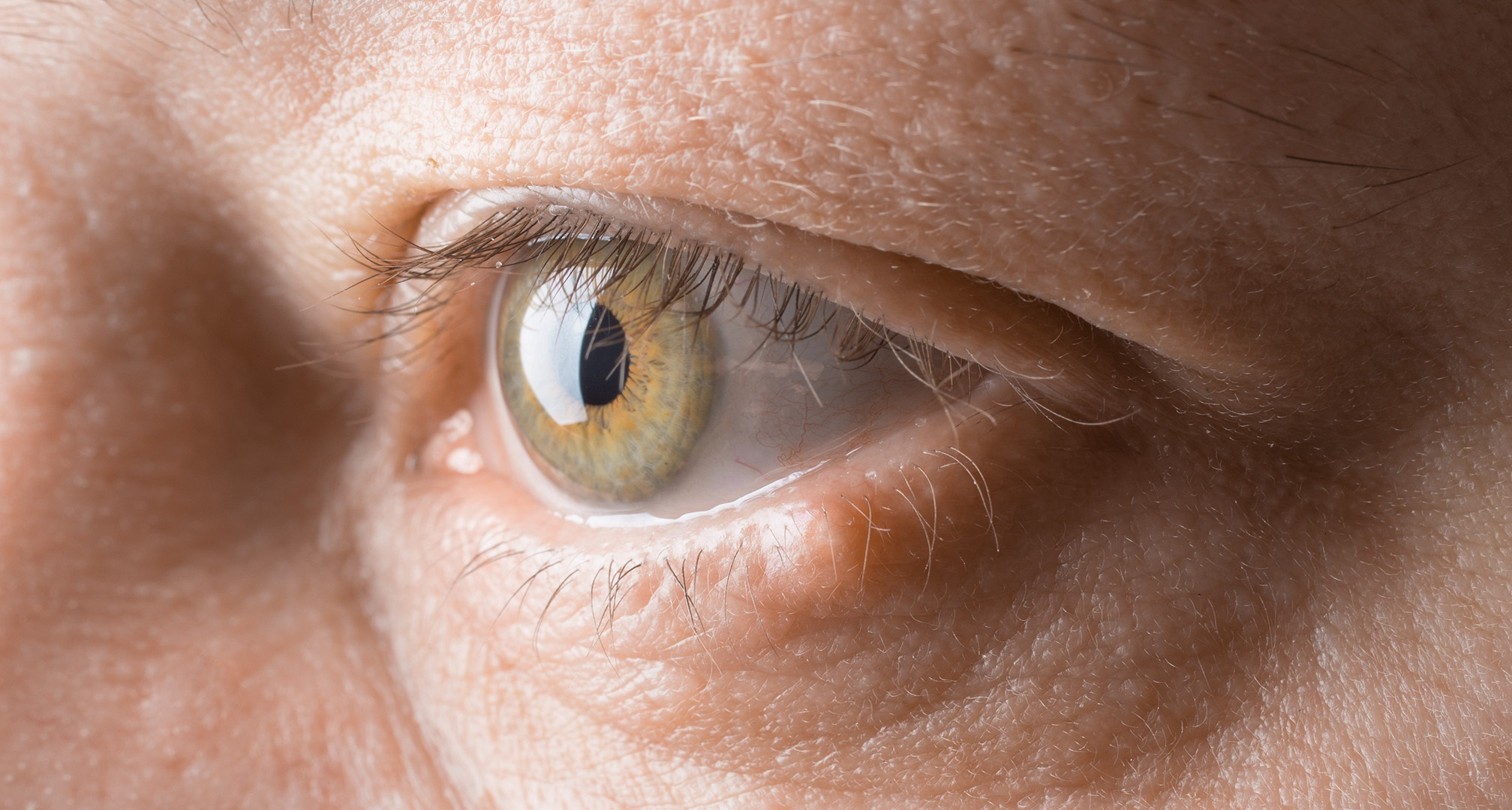 Eyelid cancer can manifest as a small nodule on the eyelid. Eyelid cancer itself doesn't affect vision, meaning your visual field will remain normal. If left untreated, however, the cancer can spread to the surrounding structures which can impact vision.
