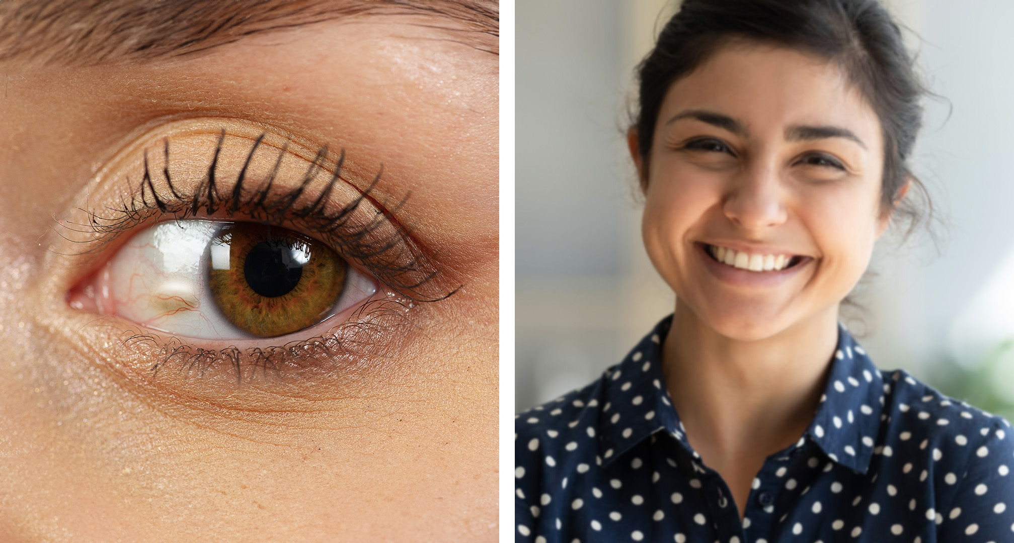 Pinguecula looks like a small, raised growth on the white part of the eye (left). The growth itself doesn't affect vision, but it can cause dryness or irritation that can lead to blurred vision (right).