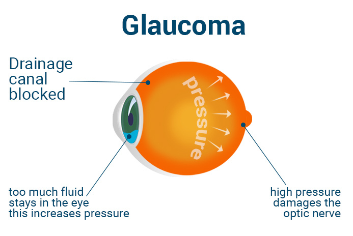 What is glaucoma?