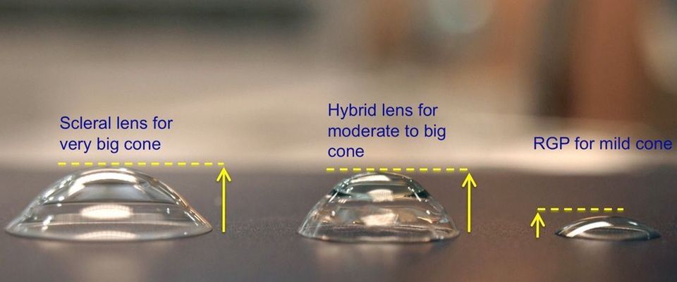 Gas Permeable Lenses (RGP)